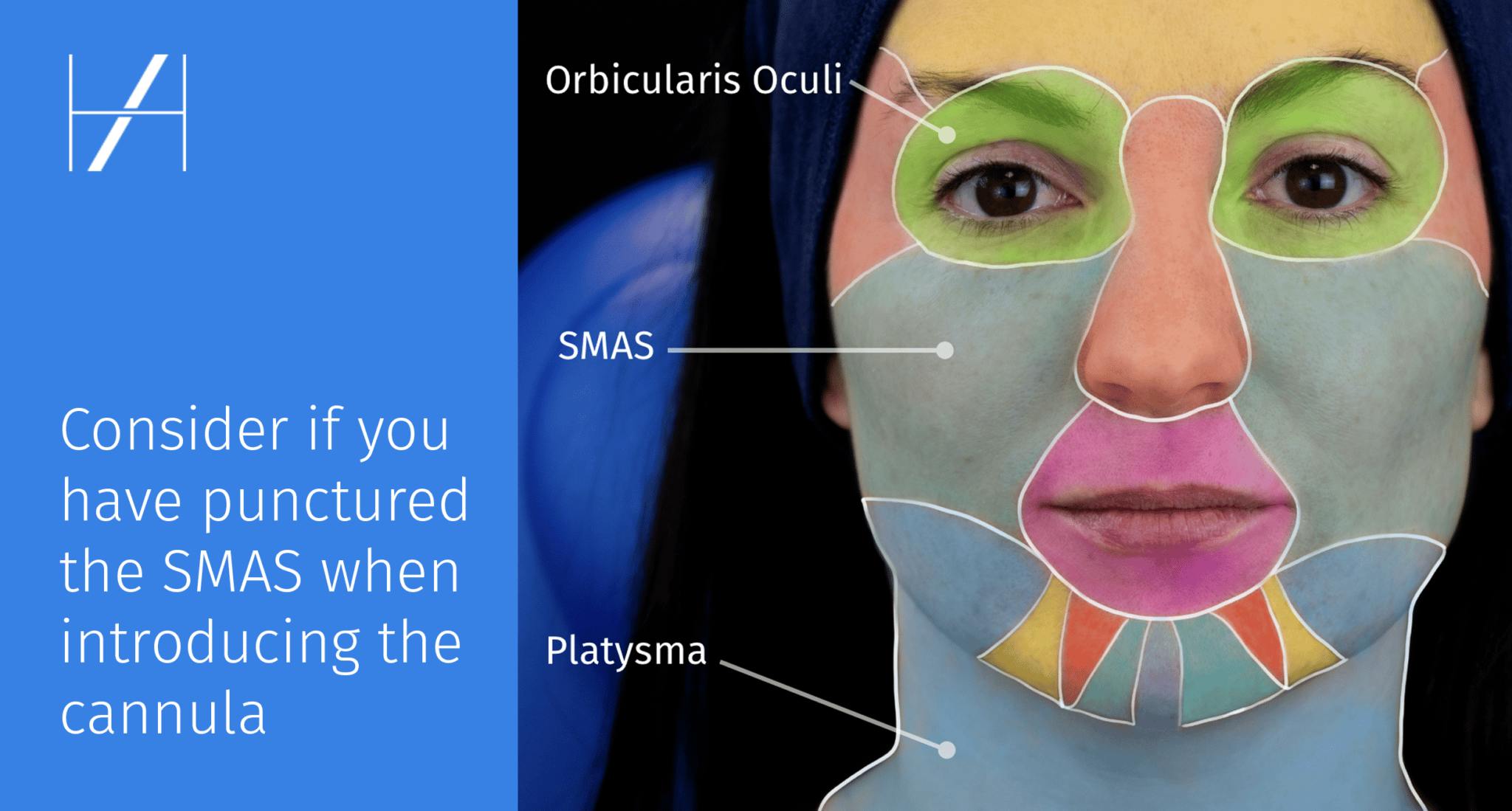 SMAS facial anatomy Learning to use a cannula for filler treatments