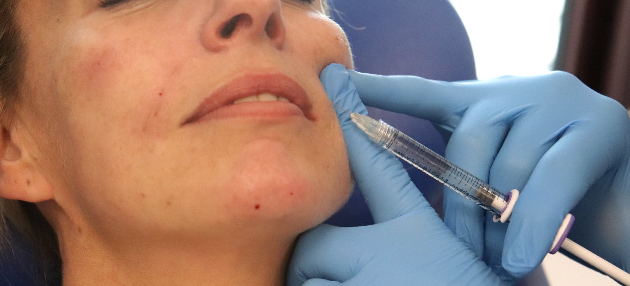 Injecting nasolabial fold filler training aesthetics