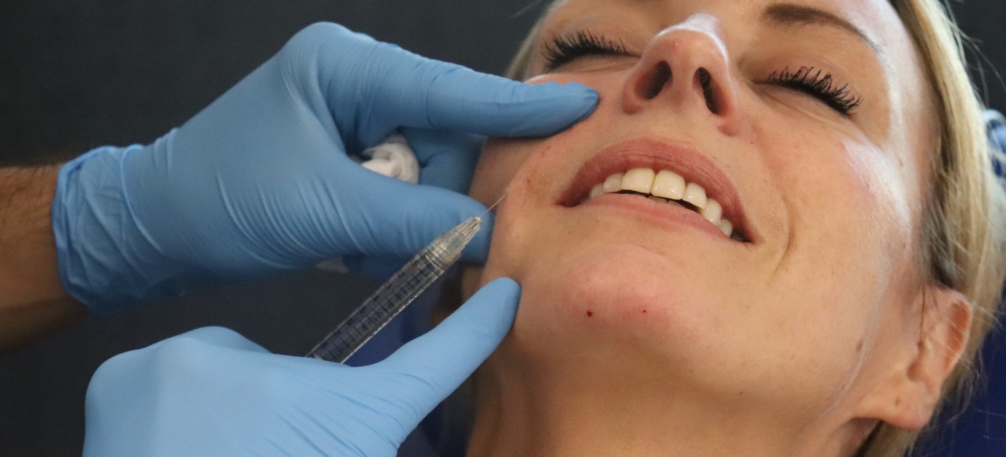 Nasolabial Fold Filler Pop Quiz!