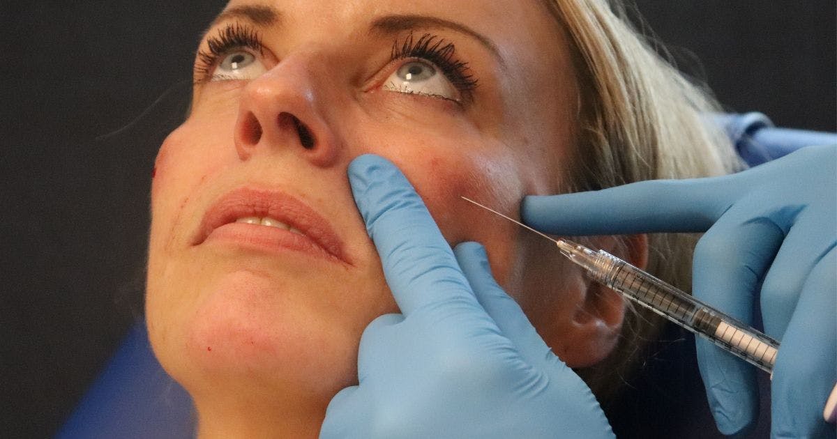 Full face filler treatment medial cheek filler injection technique