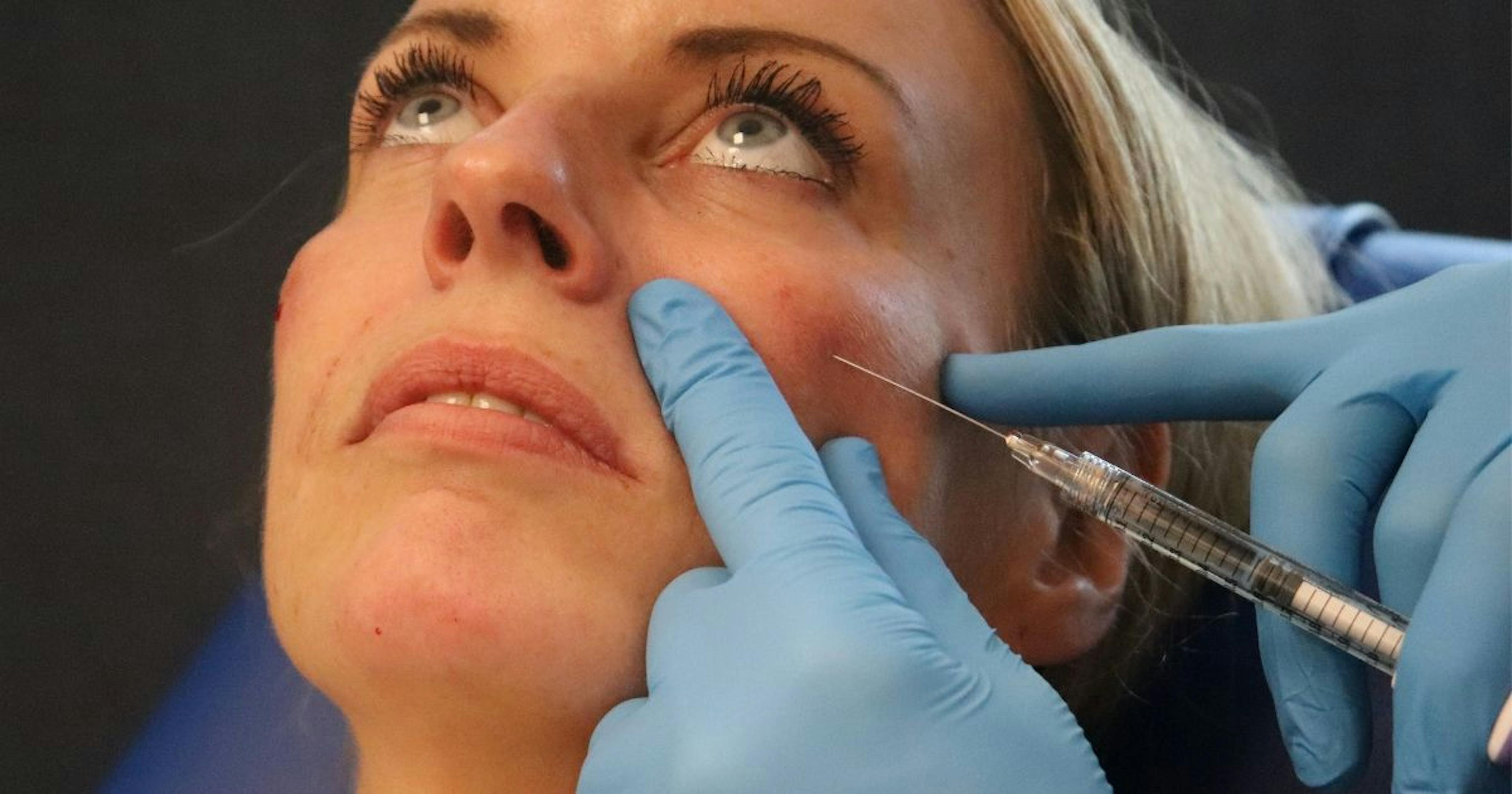 Full face filler treatment medial cheek filler injection technique