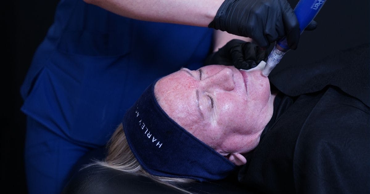 Chin Microneedling for Skin Quality Facial Anatomy Harley Academy Aesthetics Training Courses London UK