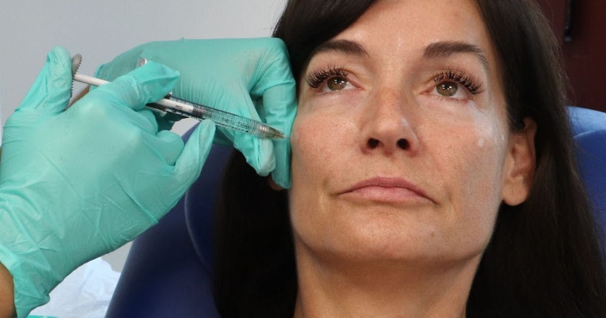 Mid-face cheek filler injection techniques