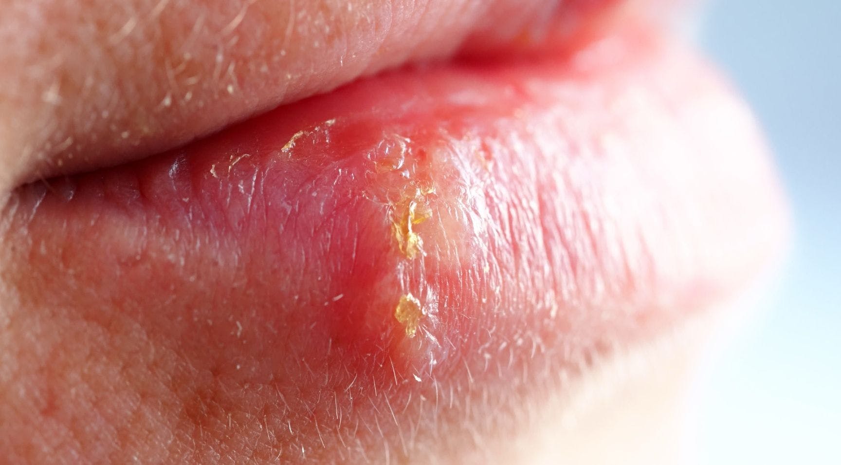 TOP BOX Herpes Activation Cold Sore Lip Filler Patients Complications