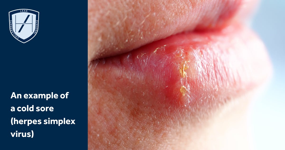 Harley Academy Cold Sore Managing Herpes Activation Dermal Filler Complications