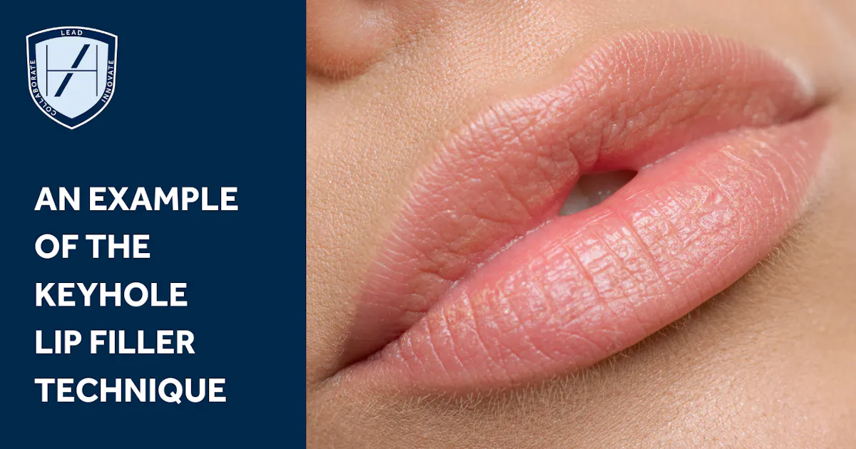 What is the Keyhole Lip Filler Technique?