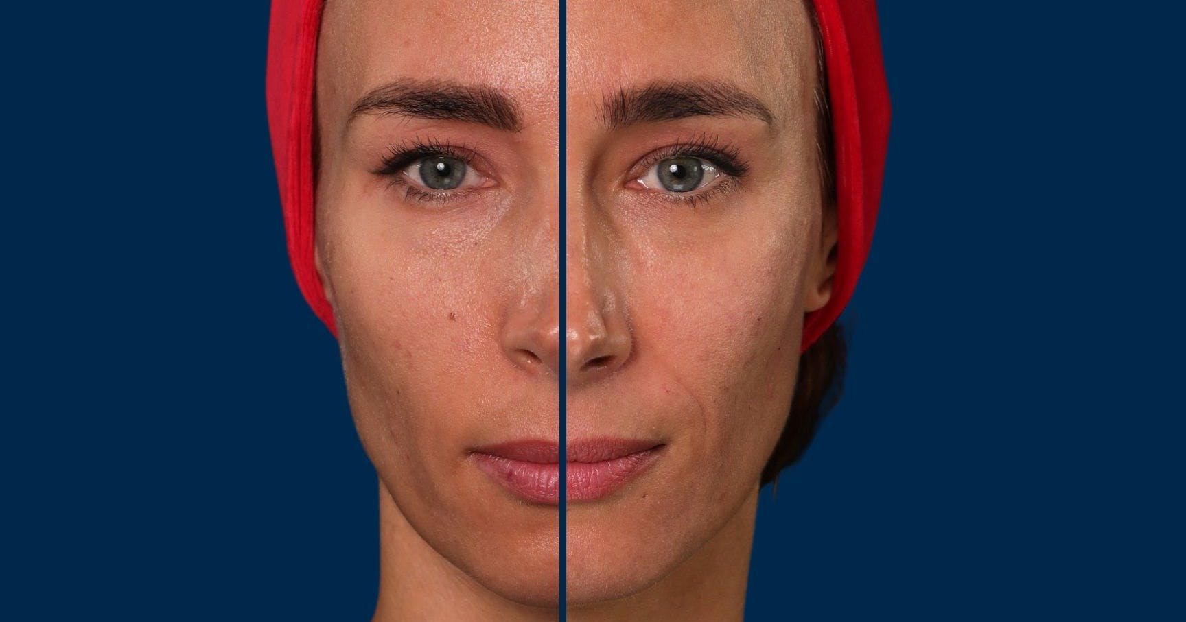 TOP BOX Subtle Facial Rejuvenation Eye Lift and Mid-Face Filler Demonstration