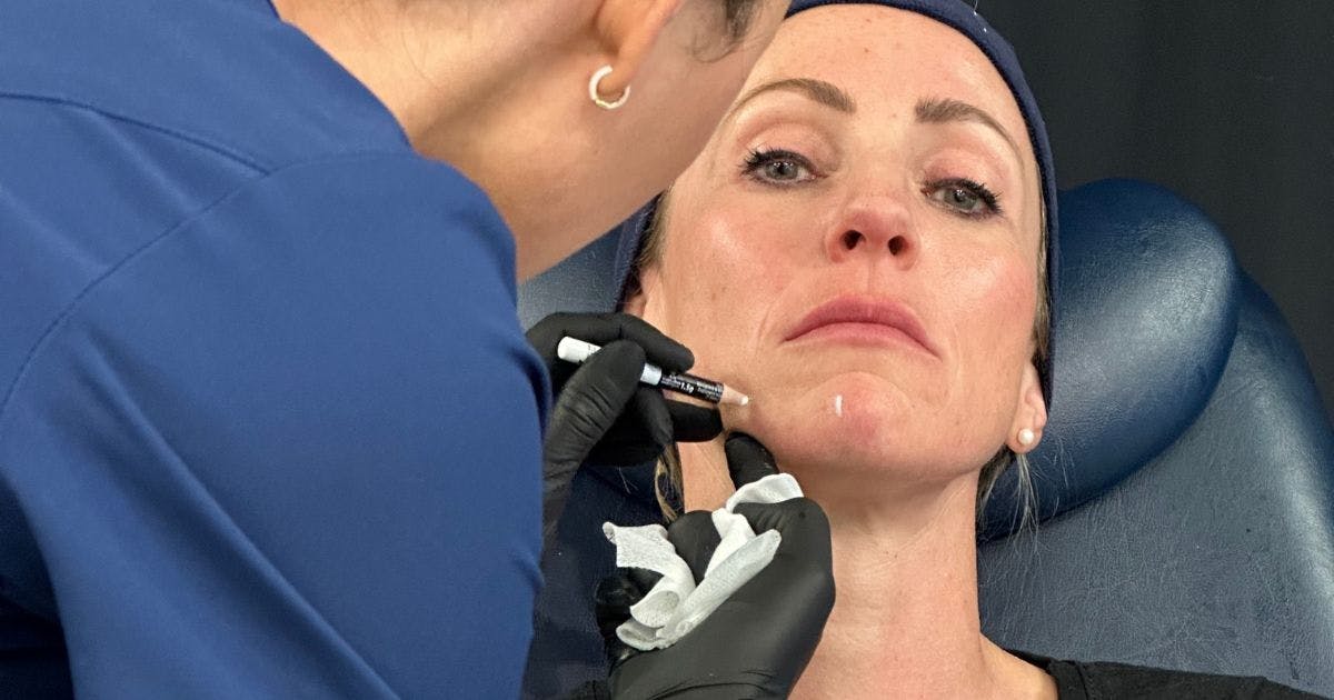 Marking up for chin botox