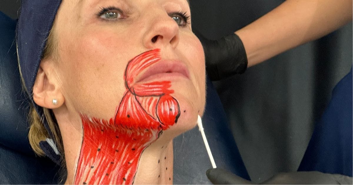 advanced toxin chin botox