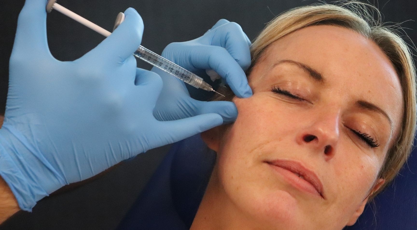 TOP BOX Cheek Filler Techniques