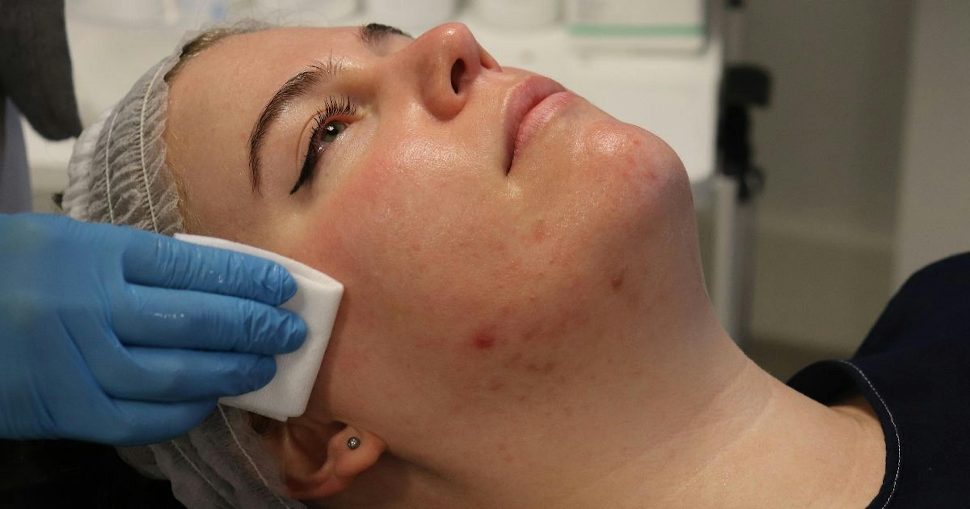acne treatment cosmetic dermatology chemical peels skin treatments