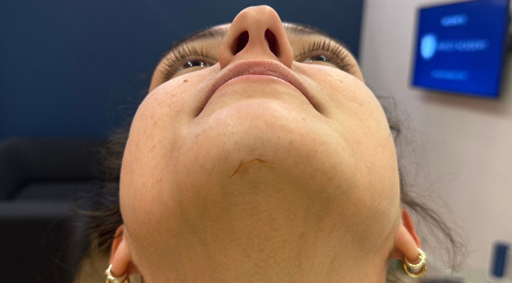 TOP BOX Improve Chin Filler Injection Techniques Facial Scarring