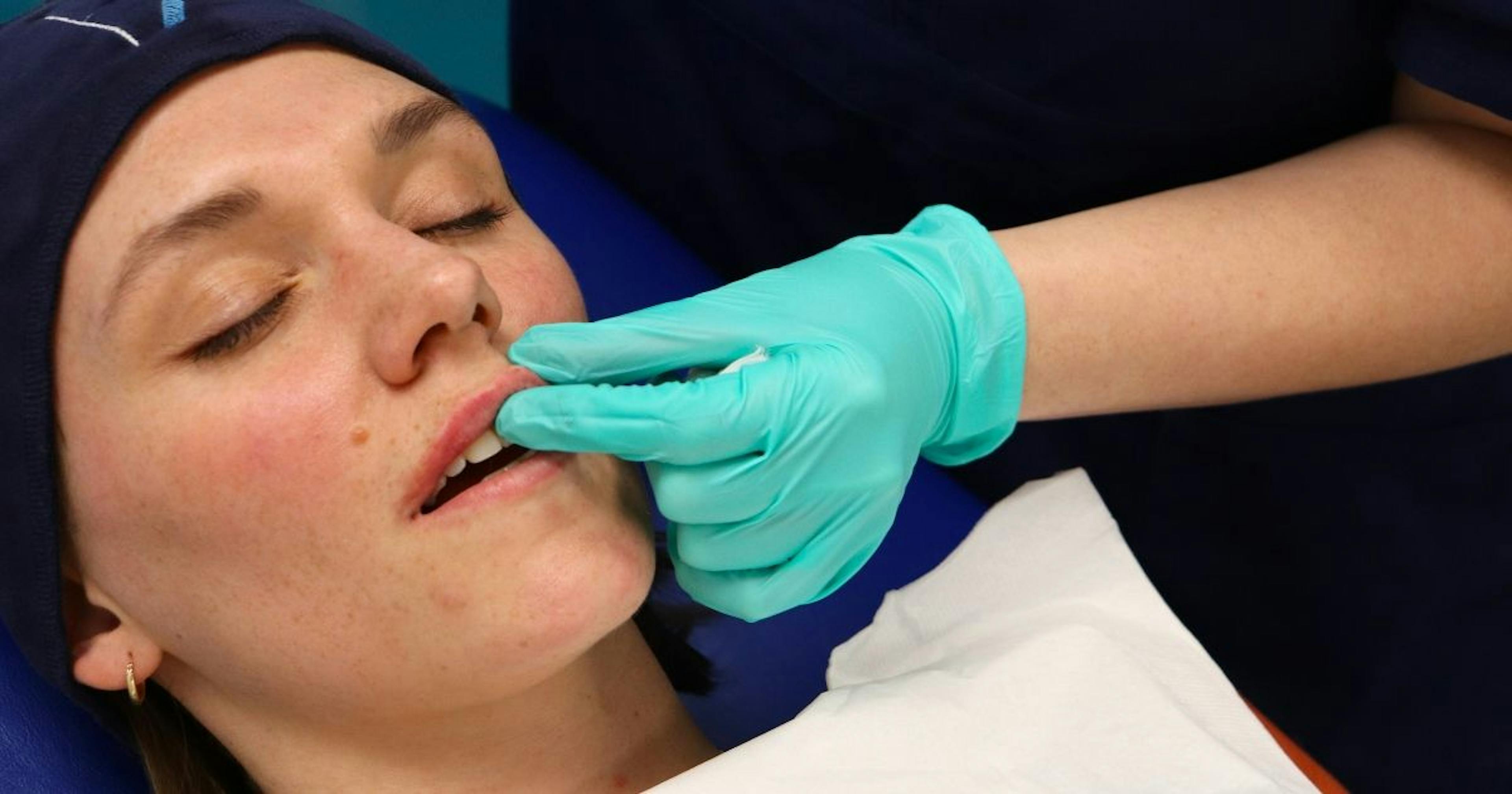 Improve Lip Filler Results Massage Techniques
