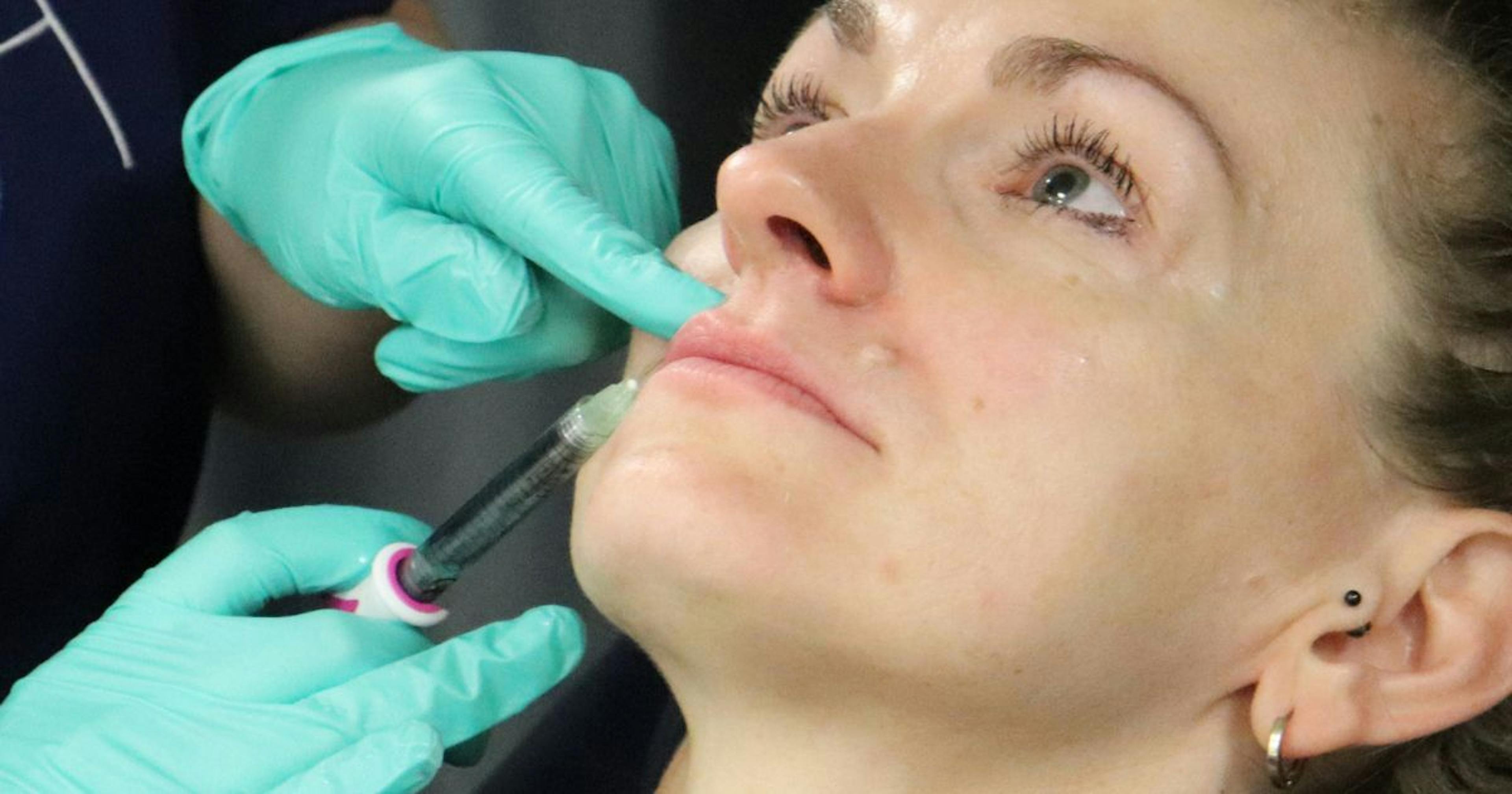 How to Inject Lip Filler When a Scar is Present