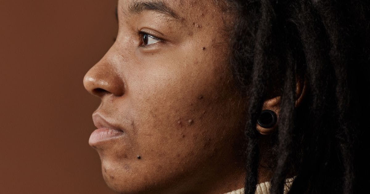 example of acne scars
