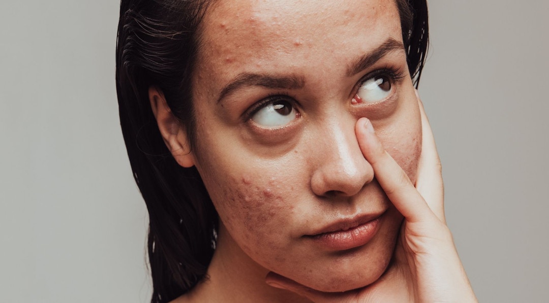 Treating Acne Scarring with Dermal Filler | Harley Academy