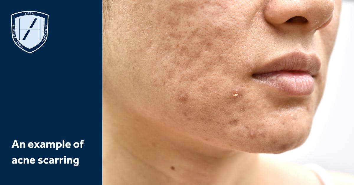 example of acne scarring