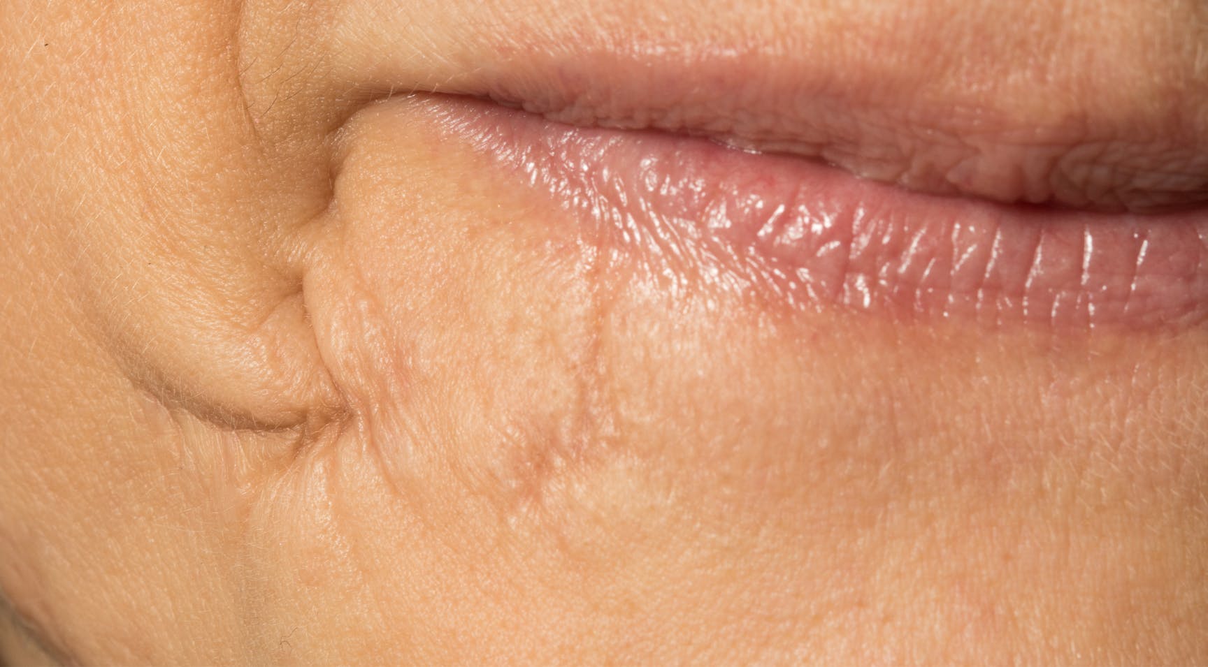 TOP BOX How to Inject Lip Filler When a Scar is Present