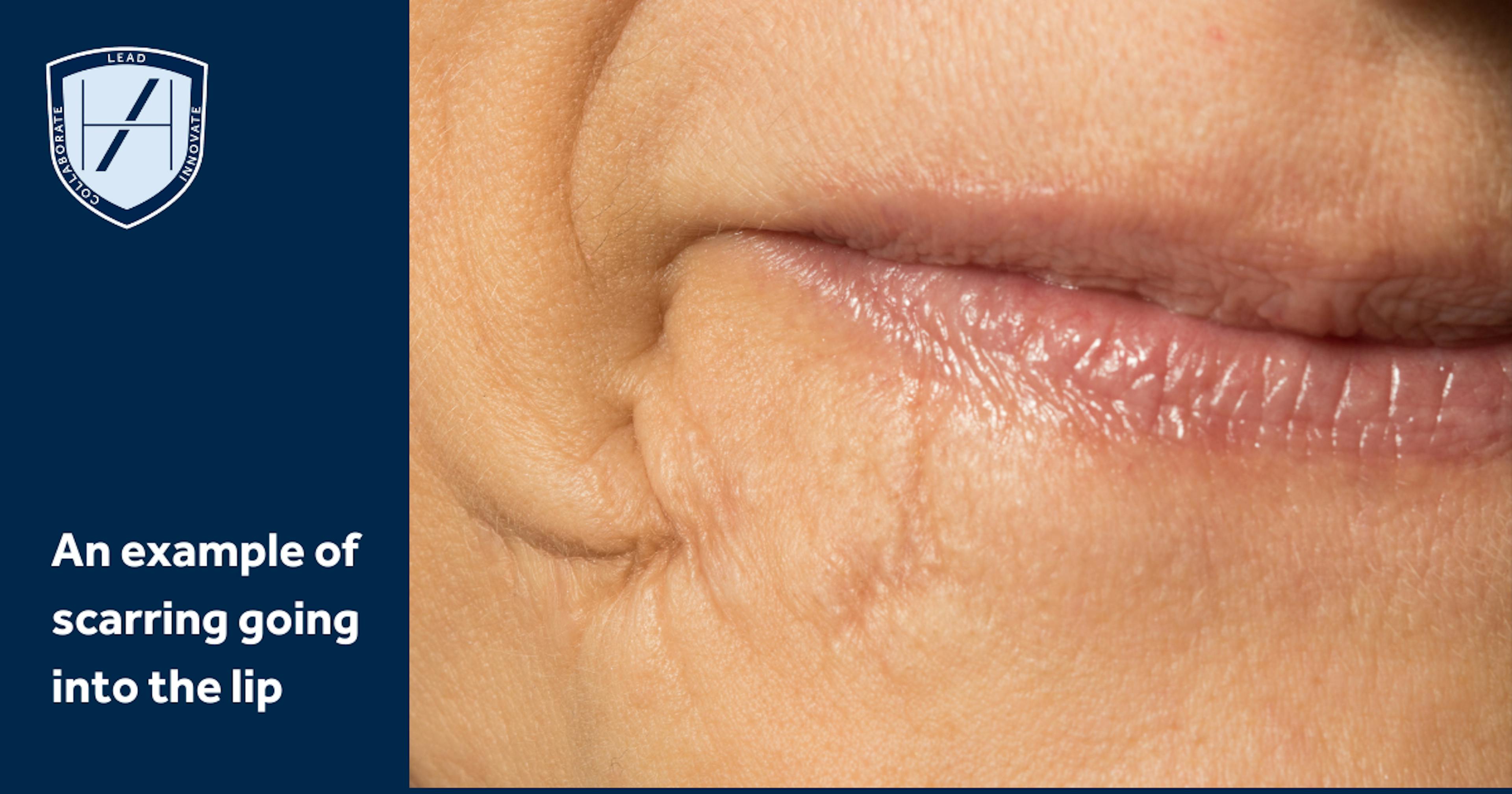 Example of Lip Scarring That May Affect Lip Filler Technique Approach