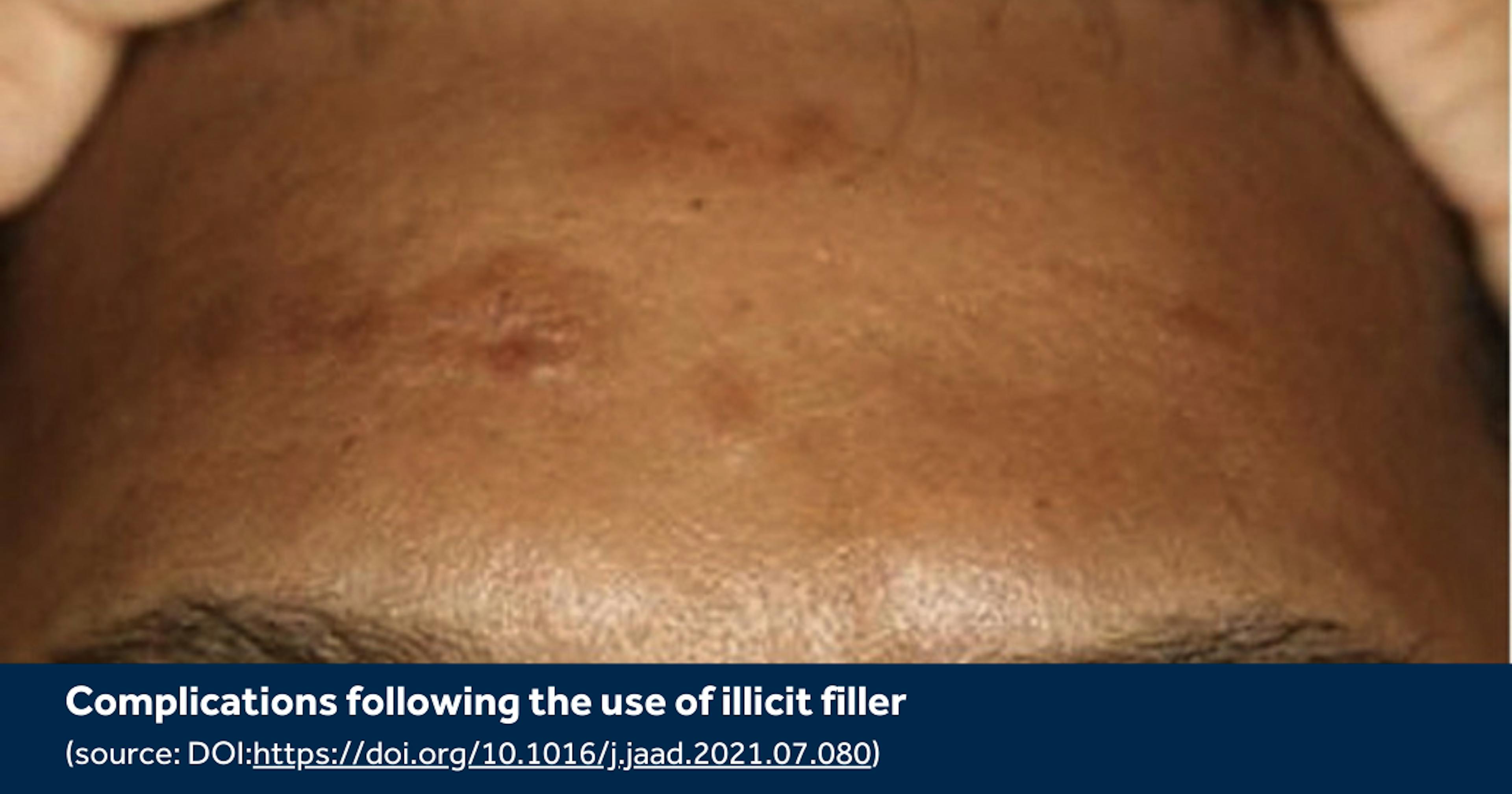Filler Complications in Skin of Colour