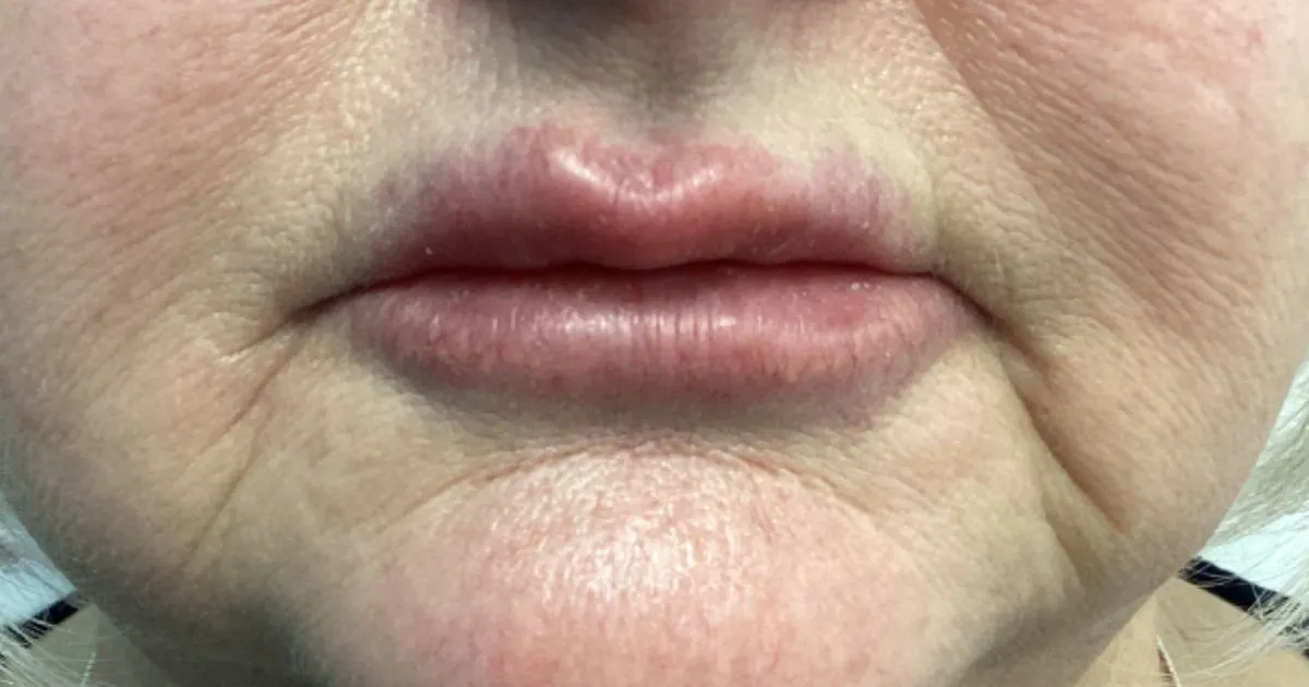An Injectors' Guide to Filler-Related Nodules