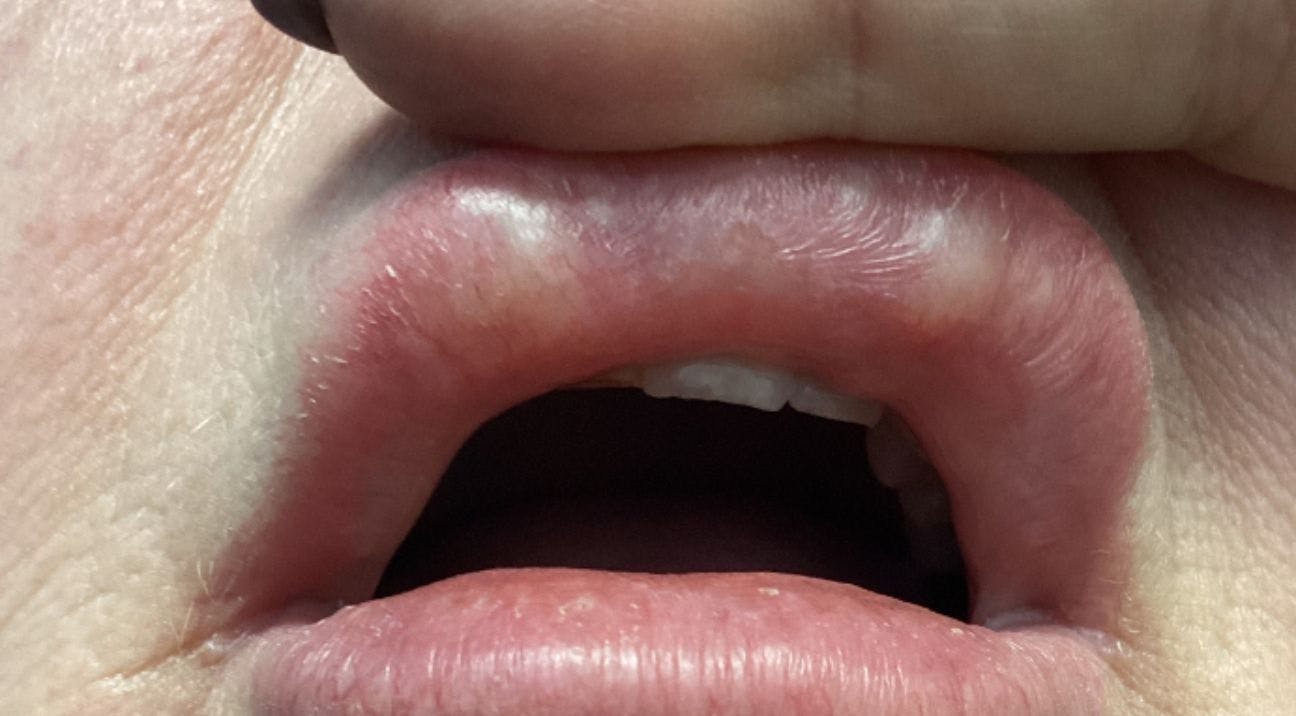 Harley Academy Inflammatory Nodules Lips Filler-Related Nodules Guide for aesthetics practitioners