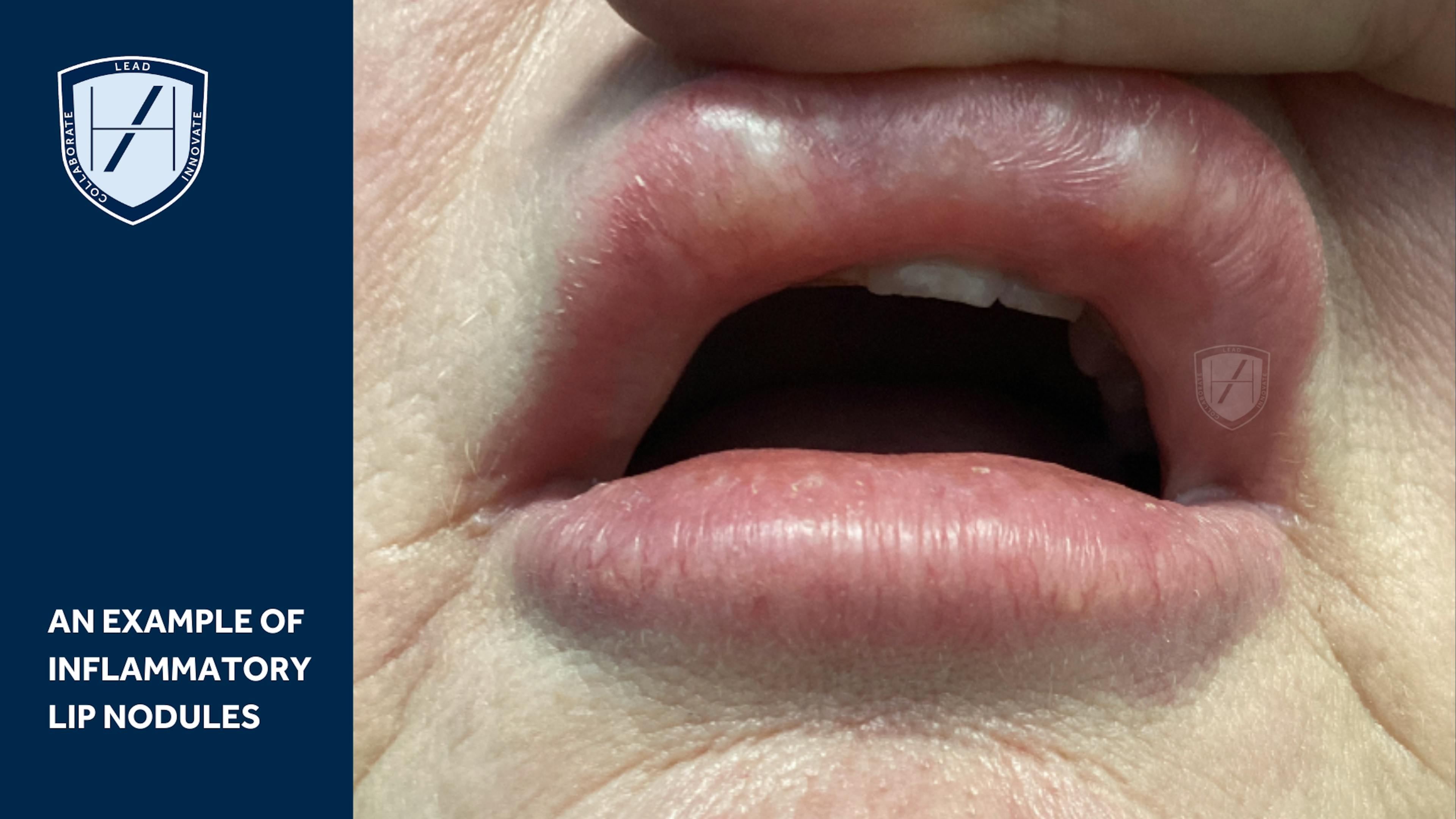 INFLAMMATORY NODULES OF THE LIPS DIAGRAM - FILLER-RELATED COMPLICATIONS