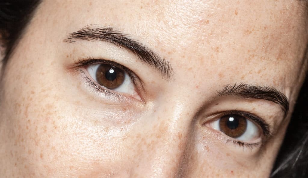 Ptosis and Botox treating hooded eyelids