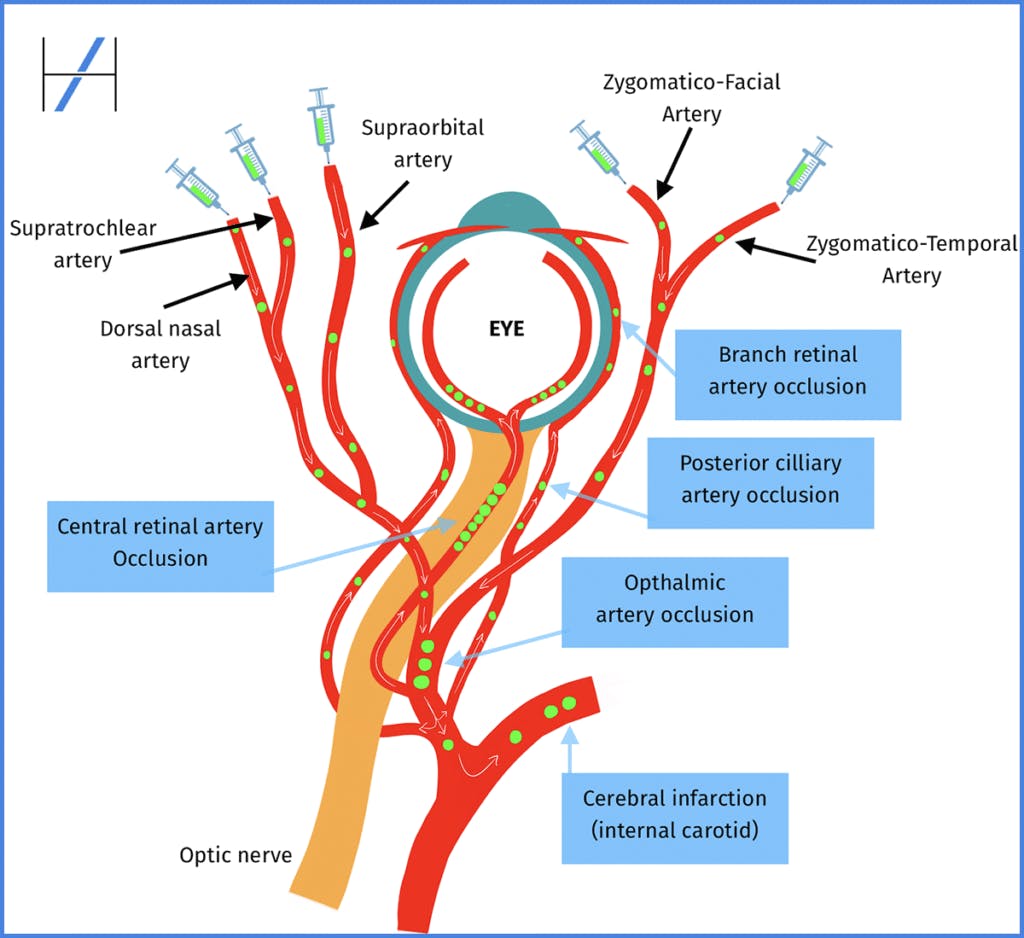 Diagram Mechanism of blindness from filler dermal fillers periorbital vascular complications