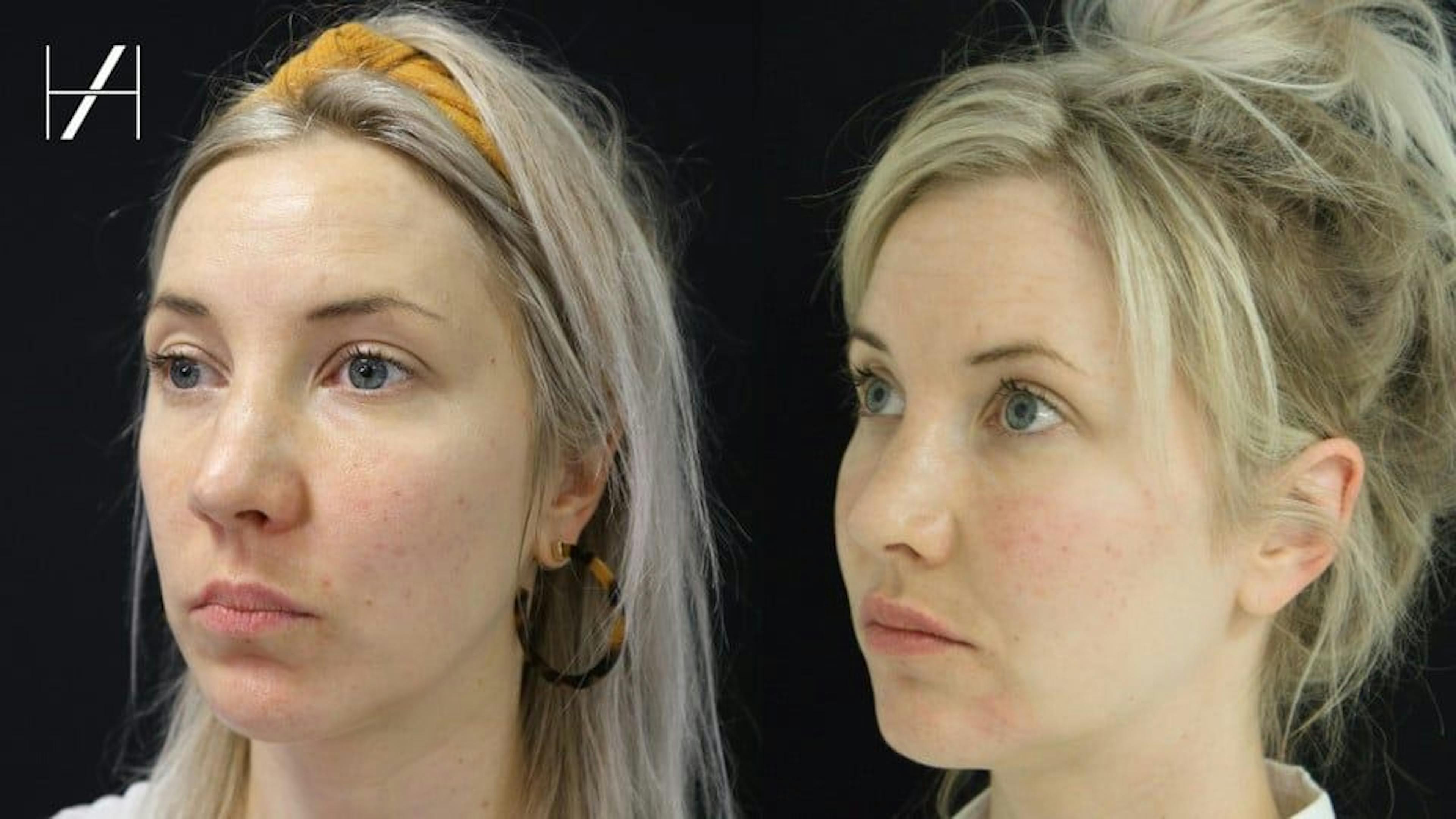 Before and After Dermal filler cheek fillers