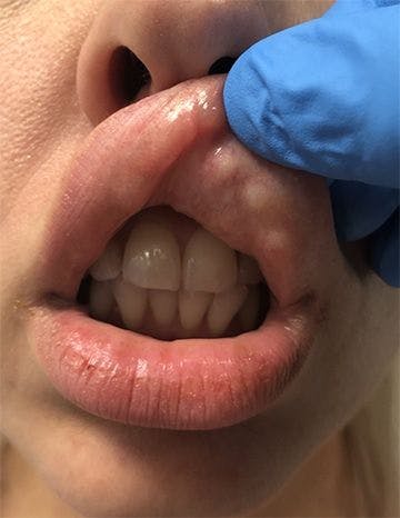 Botched lip filler complications