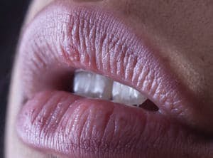 Lip Filler Technique Advice for Injectors