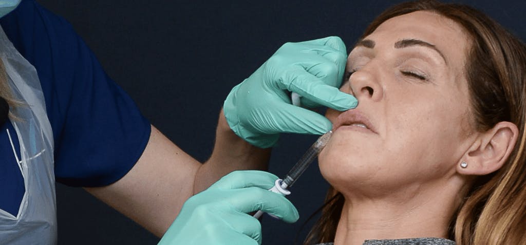 Lip filler techniques for mature patients