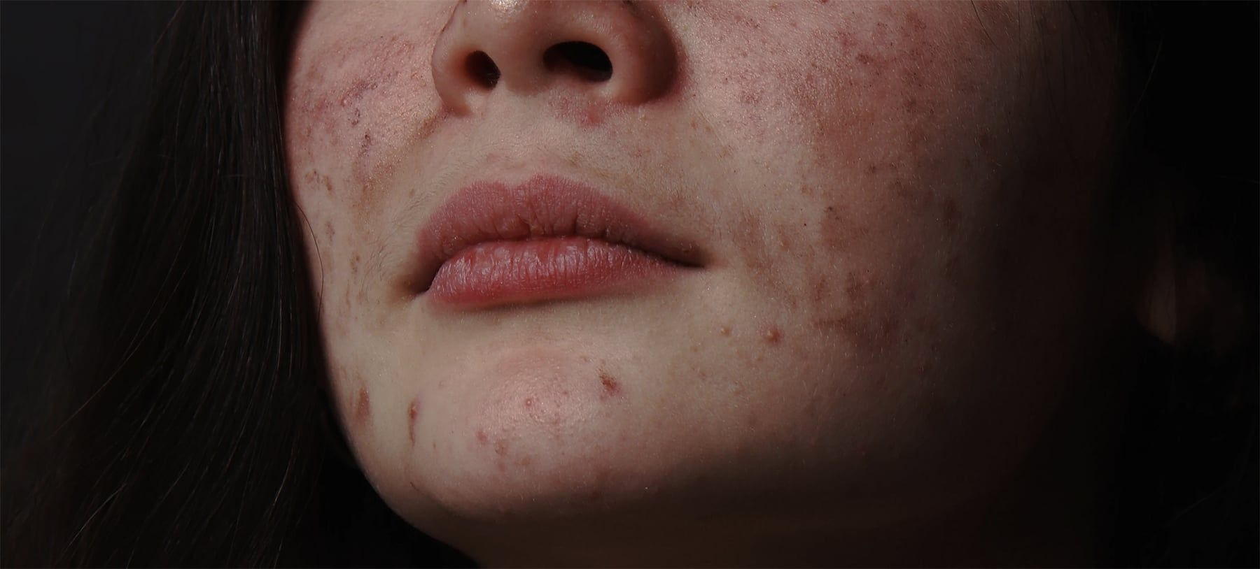 Acne Treatment For Transgender Men