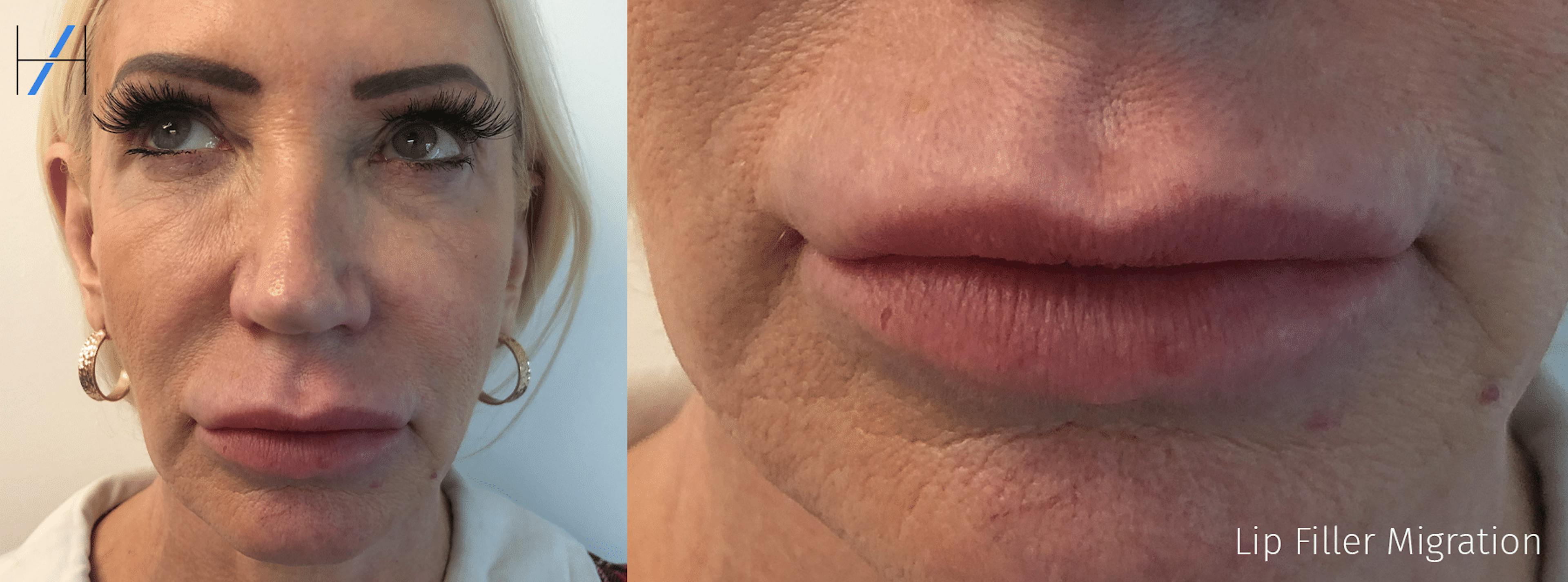 an example of lip filler migration complications