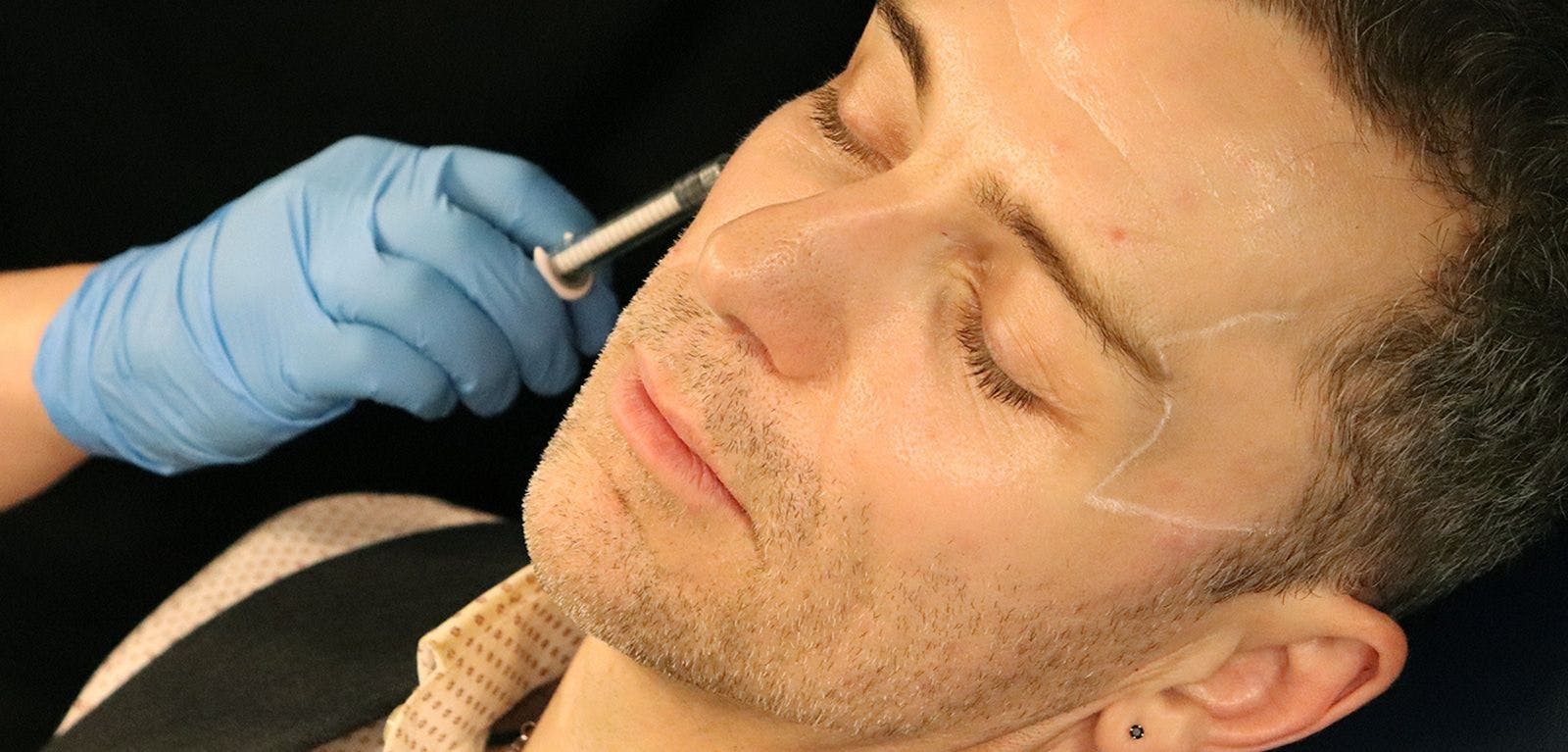 Temple Filler Harley Academy medical aesthetics training courses