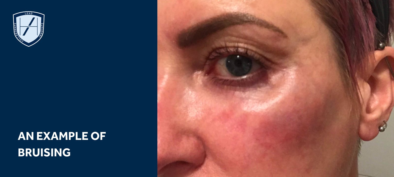 AN EXAMPLE OF bruising dermal filler complications
