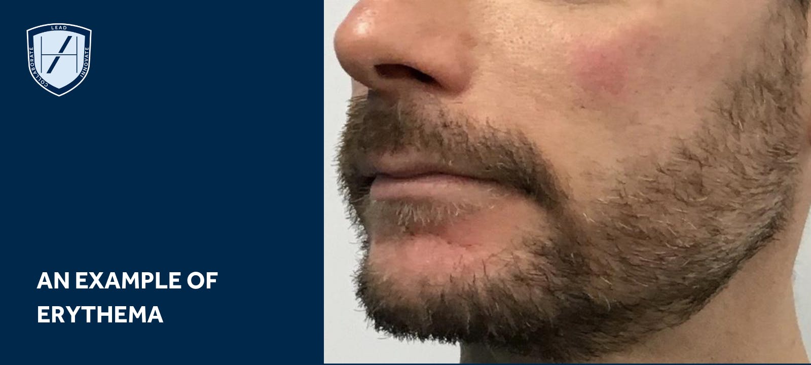 AN EXAMPLE OF erythema dermal filler complications