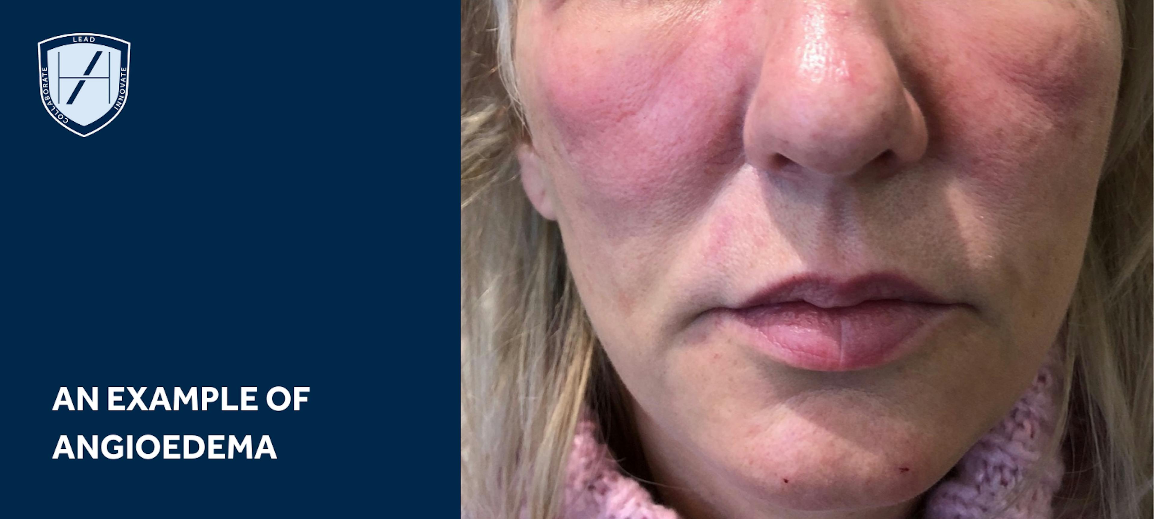 AN EXAMPLE OF angioedema dermal filler complications