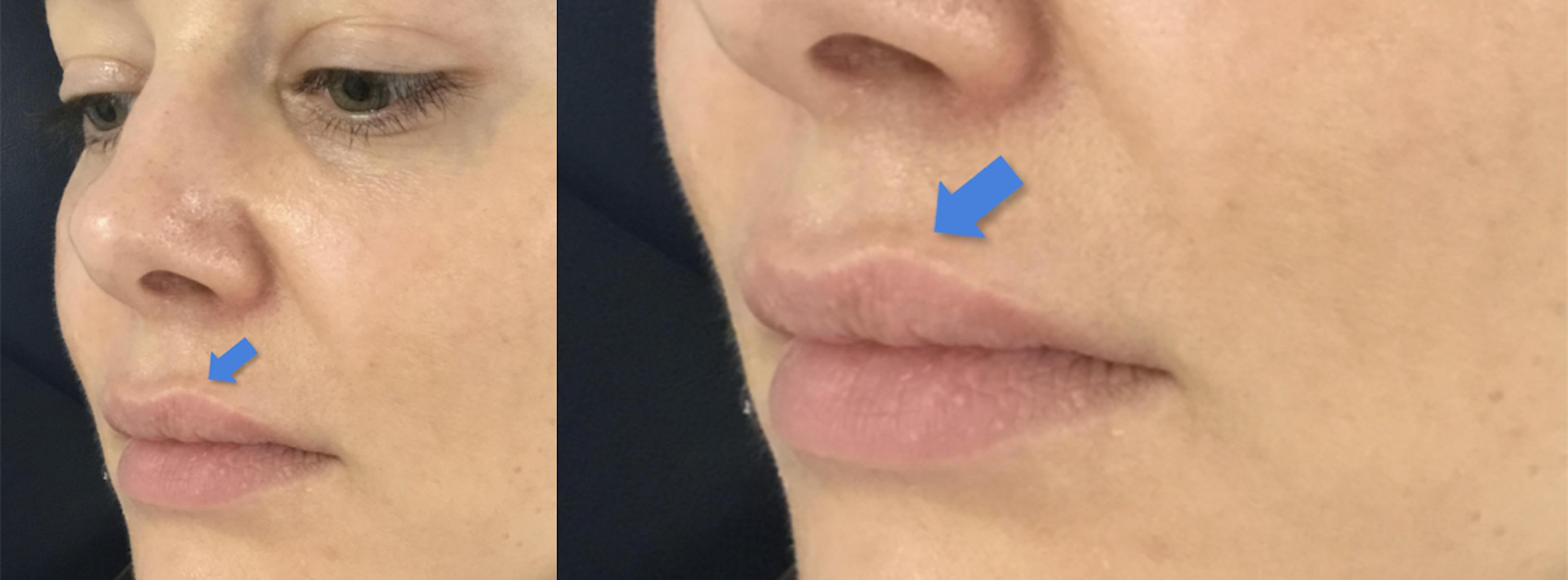 shelf like lip filler migration presentation