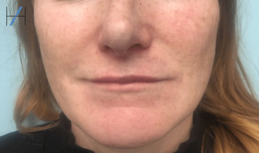 Lip Filler Vascular Occlusion Case Study