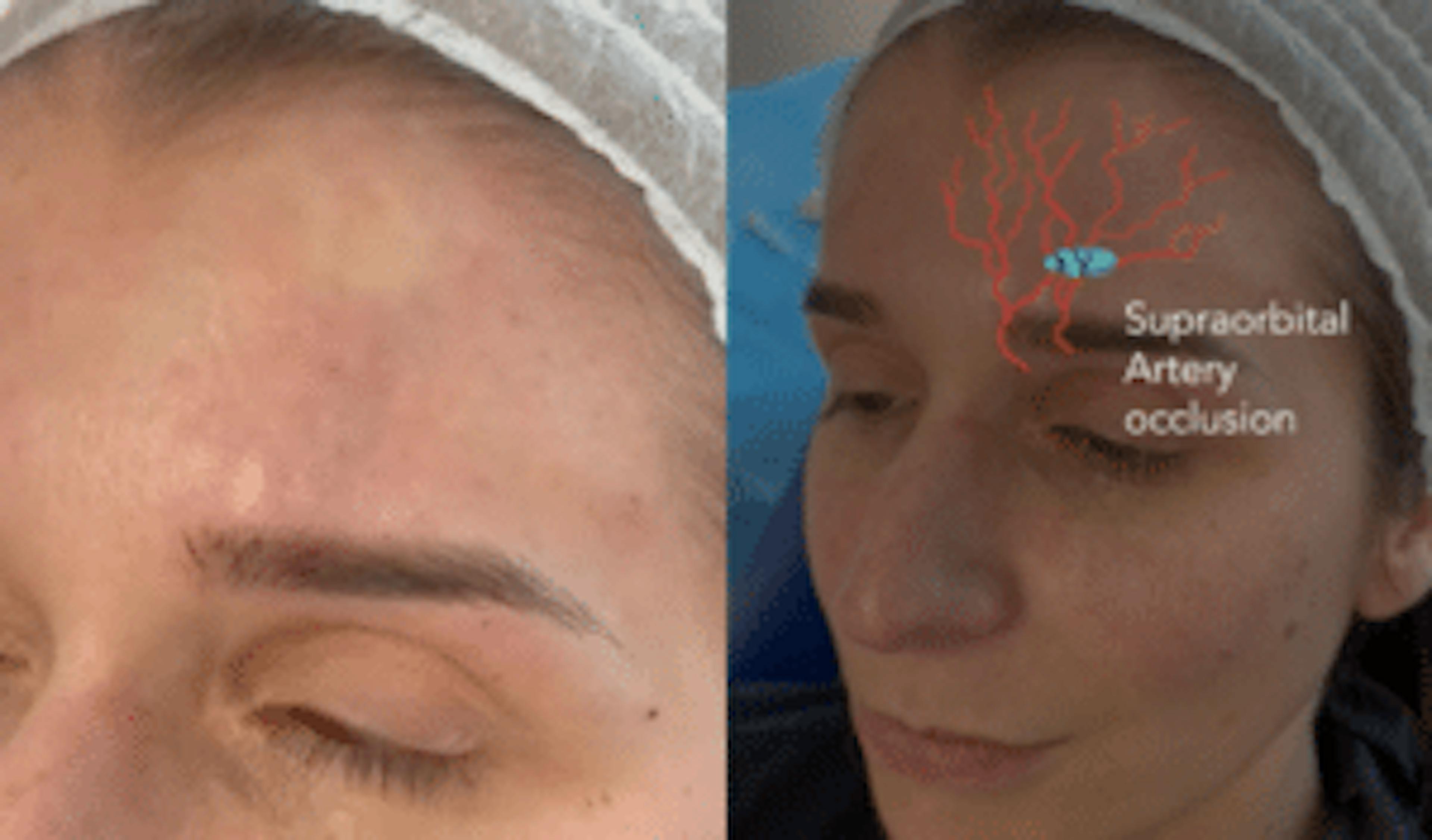  Vascular Occlusion Advice For Aesthetics Practitioners