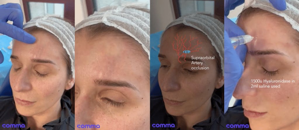 how to prevent and treat VASCULAR OCCLUSION events