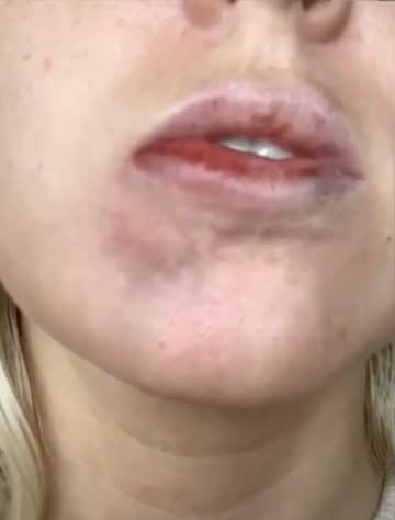 Vascular occlusion Lip Filler complications