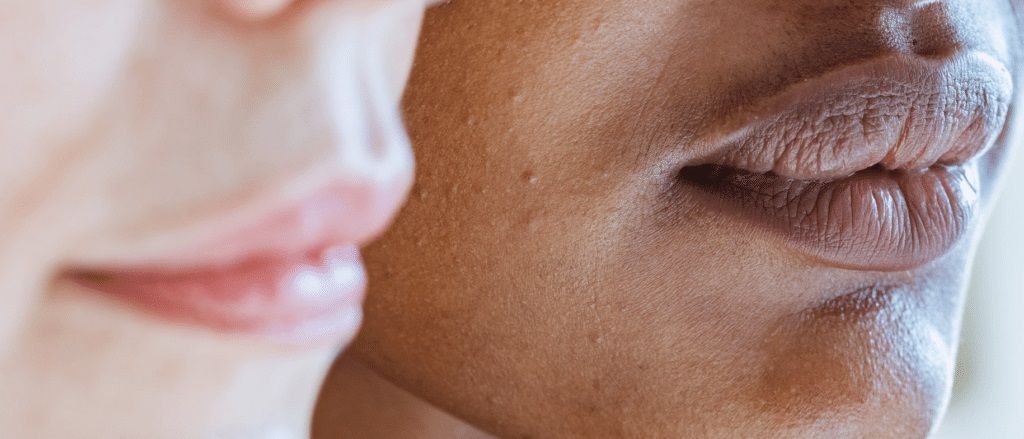 Racial Considerations For Lip Filler Proportions