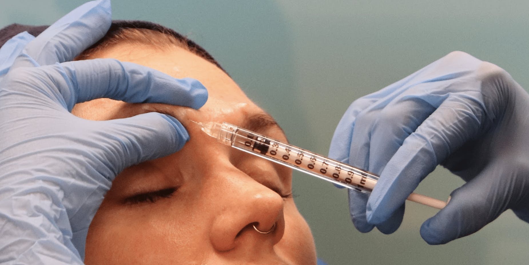 Treating Glabellar Lines botox