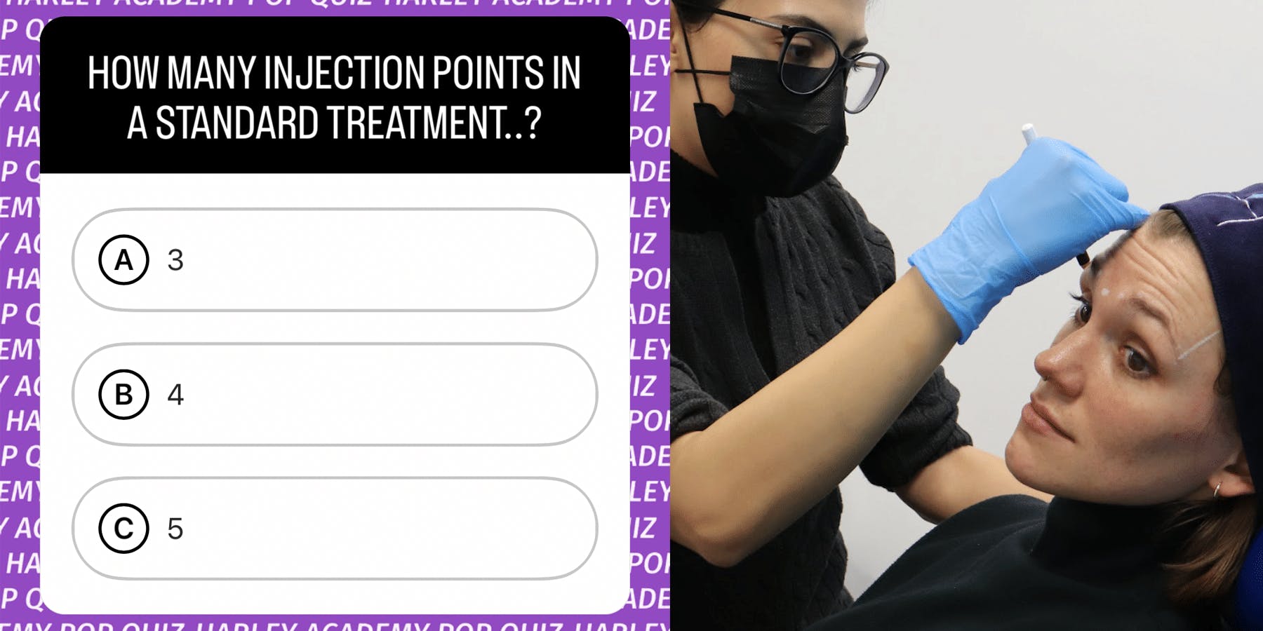 How many injection points in a standard glabellar line treatment