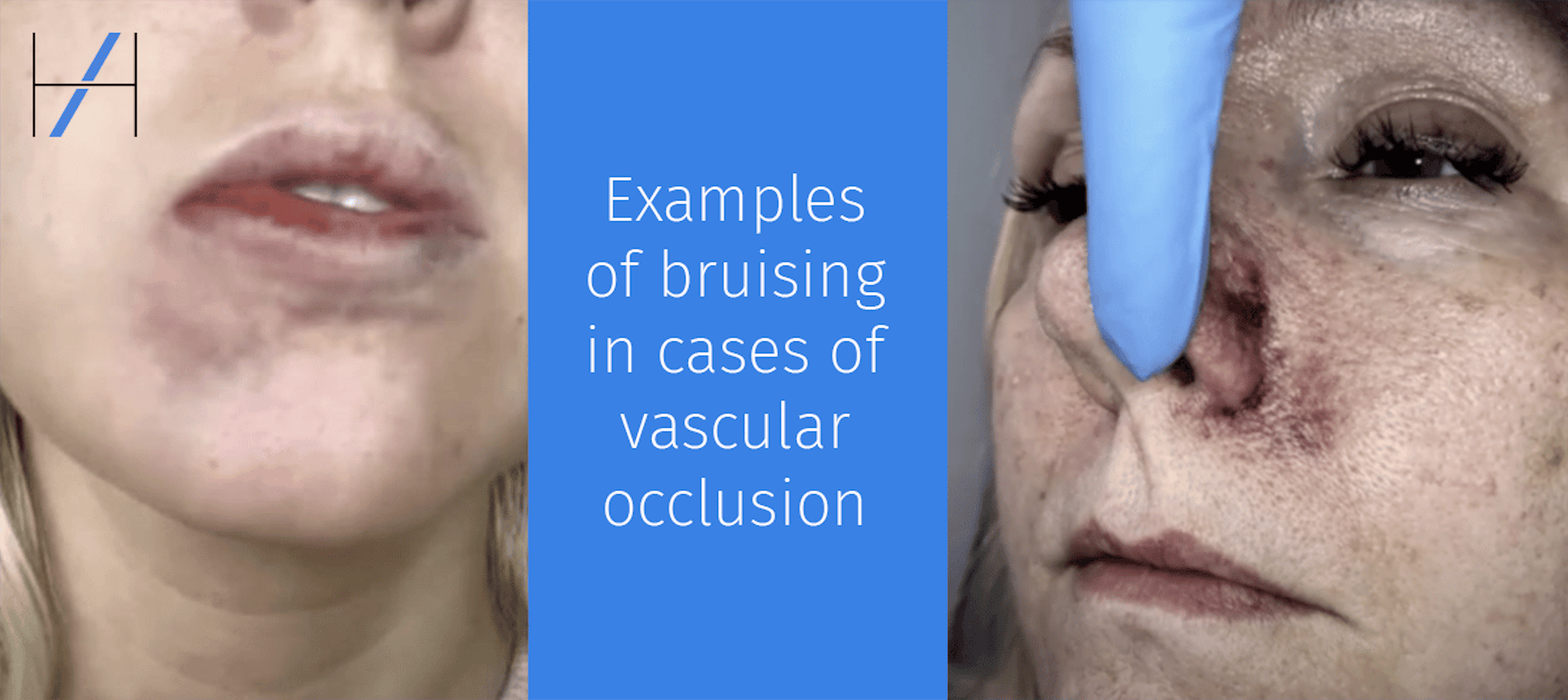 Bruising or vascular occlusion how to tell