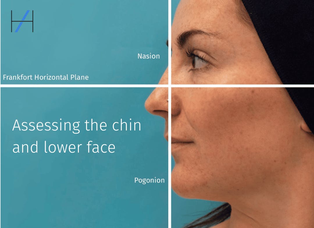 Assessing the chin and jawline
