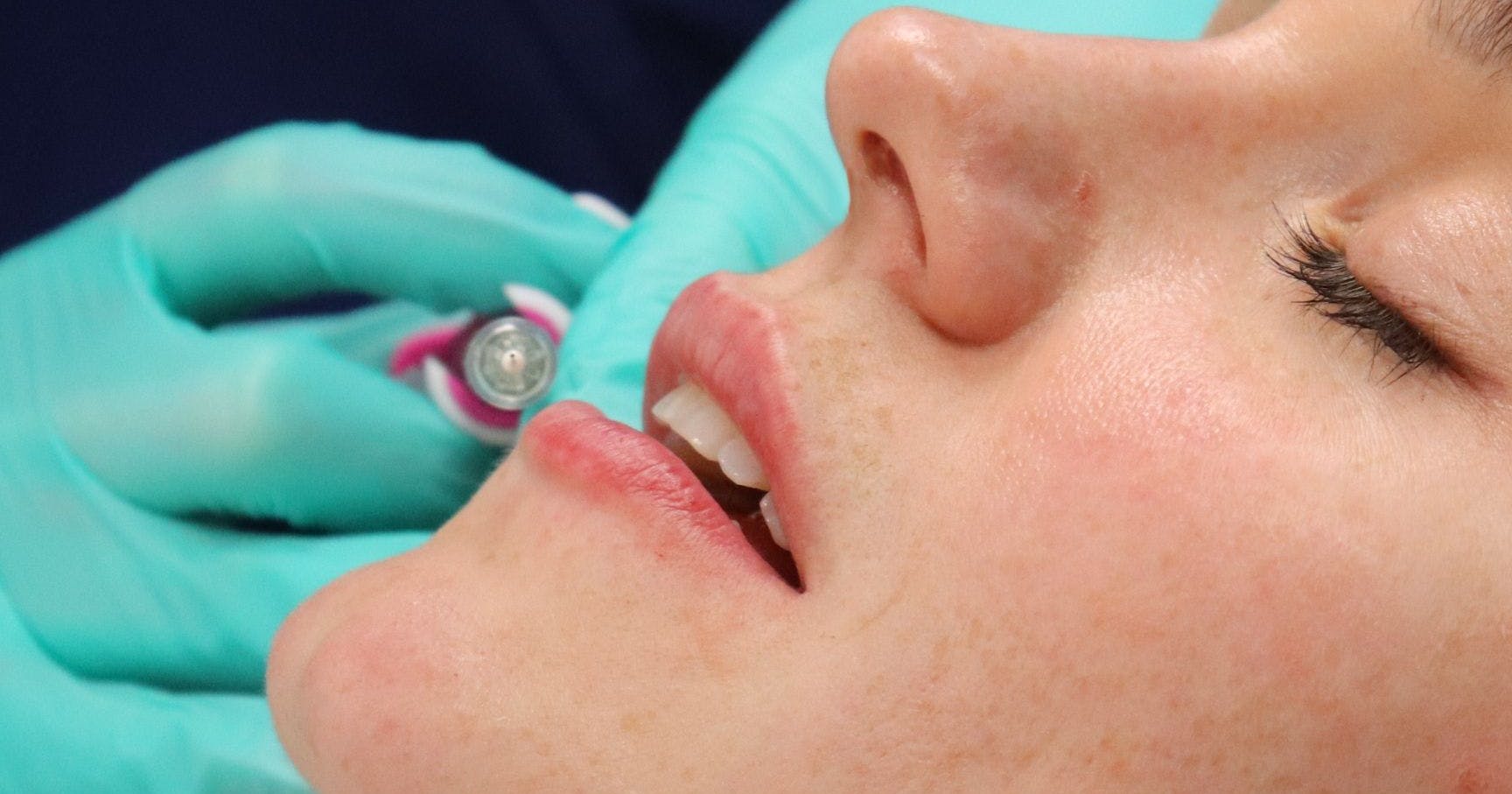 Foundation Training in Botox and Dermal Fillers